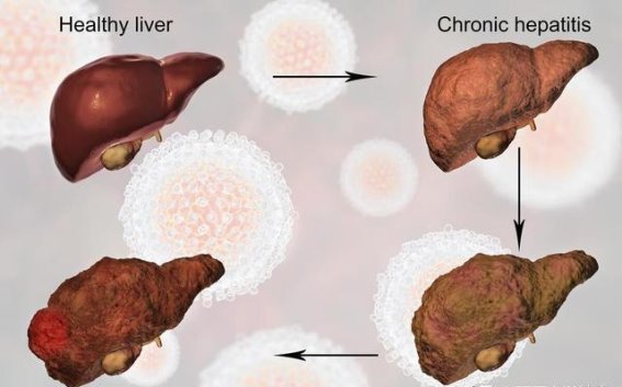 饮食与健康的奥秘：香菜、大葱与肝炎的科学探索