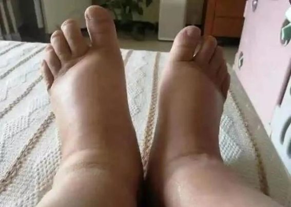 高血脂并非洪水猛兽,理性管理助力健康生活